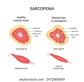 Vector illustration of healthy muscle mass and muscle loss in sarcopenia