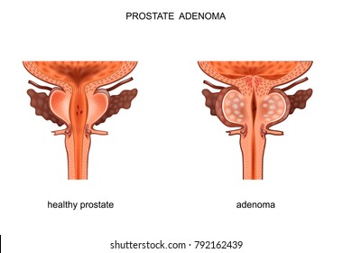 ecografia prostata valori normali