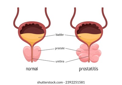 Vector illustration of a healthy prostate and prostatitis. Medical poster.
