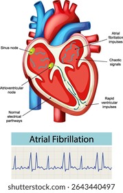 Vector illustration of heart anatomy highlighting atrial fibrillation. Includes labeled nodes and pathways with vibrant colors and clear composition