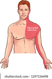  Vector illustration of a Heart attack pain location (Myocardial Infarction)