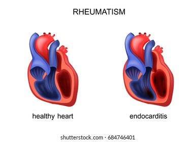 Vector Illustration Of Heart Healthy And Diseased Endocarditis
