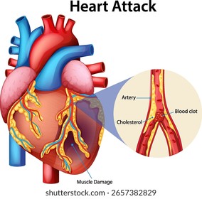 Ilustração vetorial de um coração mostrando bloqueio arterial e dano muscular. Cores vivas destacam detalhes médicos