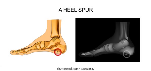 Vector Illustration Of A Heel Spur. Orthopedics
