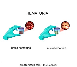 Vector Illustration Of Hematuria. Blood In Urine