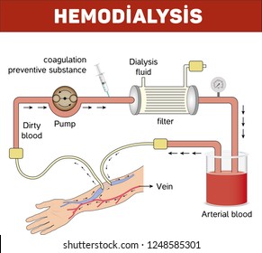 Blood Flow Through Kidney Dialysis Machine Stock Vector (Royalty Free ...