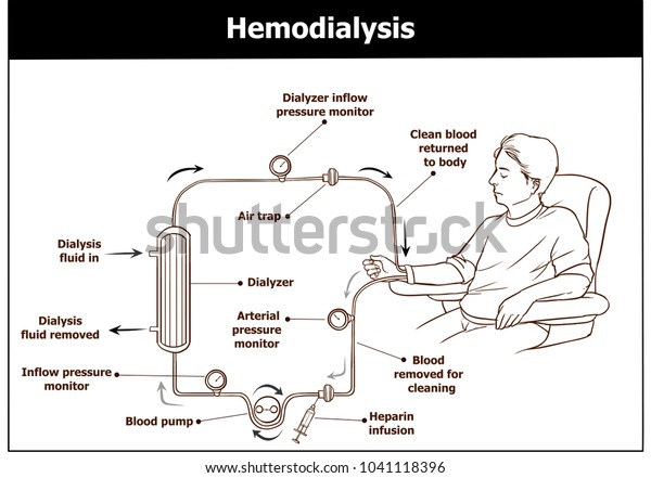heamodialysis