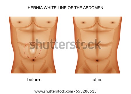 vector illustration of a hernia white line of the abdomen
