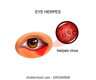 vector illustration of herpes virus of the eye
