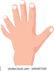 Vector Illustration of Hexadactyly, Six Fingered Hexadactyly