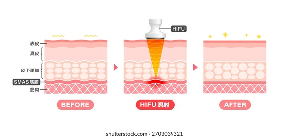 Vector illustration of HIFU mechanism and effect. Translation: Epidermis, Dermis, Fat Layer, Fascia, Muscle, irradiation.