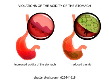 vector illustration of high and low acidity of the stomach
