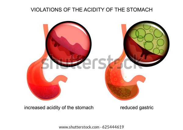 Vector Illustration High Low Acidity Stomach Stock Vector (Royalty Free ...