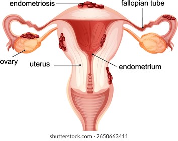 Ilustração vetorial destacando endometriose no sistema reprodutor feminino, apresentando anatomia rotulada e cores vibrantes