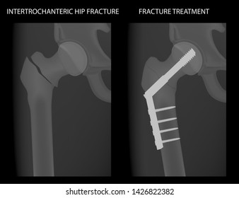 Vector illustration hip joint problem, x-ray of intertrochanteric hip fracture treatment with a metal plate and a big screw. For advertising and medical publications.