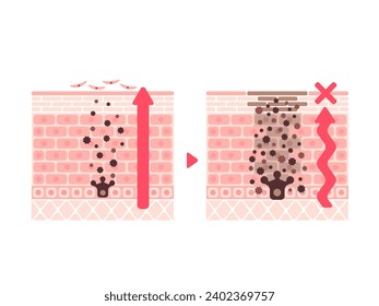 Vector illustration of how skin spots (hyperpigmentation) are created.