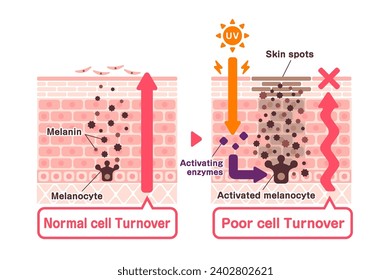Vector illustration of how skin spots (hyperpigmentation) are created. 