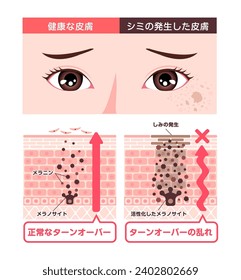 Vector illustration of how skin spots (hyperpigmentation) are created. Translation: Normal skin, skin spots, melanin, melanocyte, spot, normal turnover, Poor turnover.