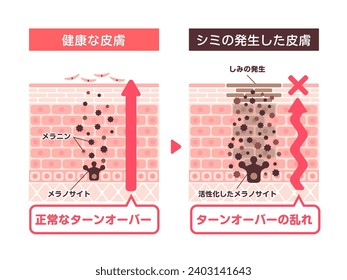 Vector illustration of how skin spots (hyperpigmentation) are created. Translation: Normal skin, skin spots, melanin, melanocyte, spot, normal turnover, Poor turnover.