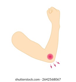 Ilustração vetorial do braço humano mostrando dor no cotovelo com inflamação vermelha e símbolos de dor. Adequado para conteúdo médico, ortopédico, de saúde e relacionado a lesões.