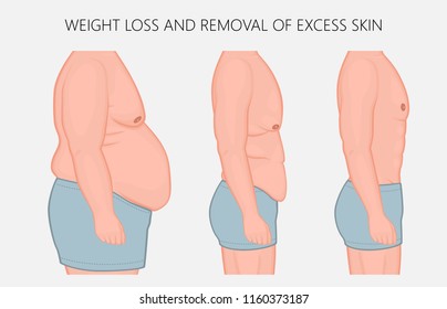 Vector illustration. Human body problem after Weight loss, excess skin  removal in man. Side view. For advertising of cosmetic plastic procedures, for medical publications. EPS 10