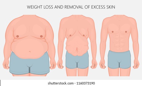 Vector illustration. Human body problem after Weight loss, excess skin  removal in man. Front view. For advertising of cosmetic plastic procedures, for medical publications. EPS 10