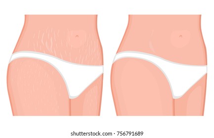 Vector illustration of human body problem. Healing of stretch marks on European, Asian women belly and legs. For advertising, medical publications, use on package of medicinal products, creams. EPS 8