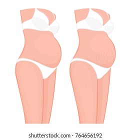 Vector illustration of human body problem. Stretch marks on European, Asian pregnant women belly and legs. For advertising, medical publications, use on package of medicinal products, creams. EPS 8