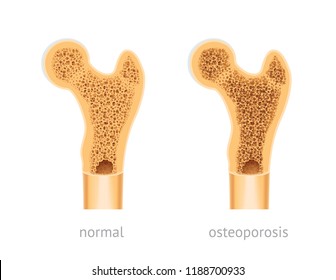 Vector illustration of human Bone, healthy and with osteoporosis