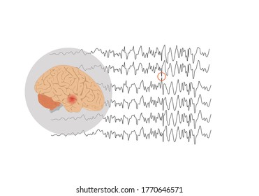 Vector Illustration Of Human Brain And Abnormal Brain Waves Waves Representing Focal Seizure At Temporal Lobe