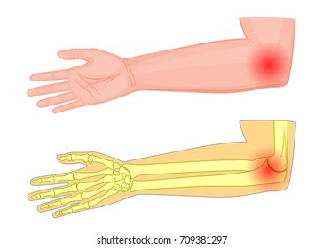 Vector illustration of a human elbow joint with a pain or injury. Medial view. For advertising, medical publications. EPS 10