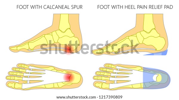 heel spur relief cushions