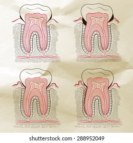 vector illustration human gum disease