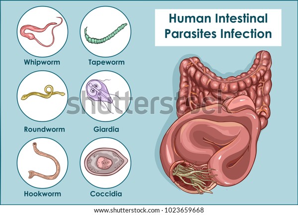 ヒトの腸内寄生虫のベクターイラスト のベクター画像素材 ロイヤリティフリー