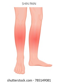 Vector illustration of a human legs (anterior and medial view) with shin pain. Vector illustration for advertising, medical (health care) publications. EPS 10