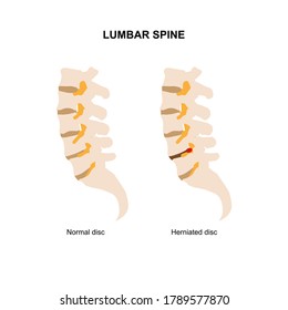 Ilustración vectorial de la columna lumbar humana que muestra un disco lumbar normal y hernificado.