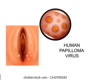 Penyebab humán papilloma vírus, A nyakán lógó papillómák