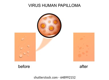 vector illustration of a human papilloma virus
