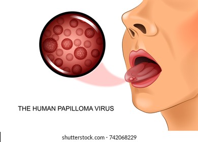 vector illustration of human papillomavirus on tongue