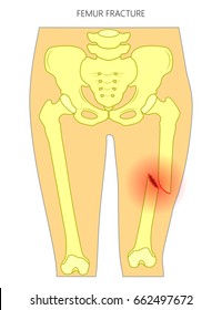 Vector illustration of a human pelvis and hip with femur shaft fracture (broken thighbone). Front view. For advertising and medical publications. EPS 10.