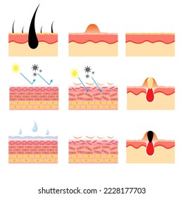 vector illustration of human skin structure anatomy. various skin conditions. epidermis and desmis. illustration for science and medical health.