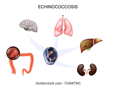 vector illustration of hydatid cyst of the brain, liver, lungs and kidneys. the causative agent Echinococcus
