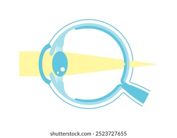 Vector illustration of hyperopia (no text)