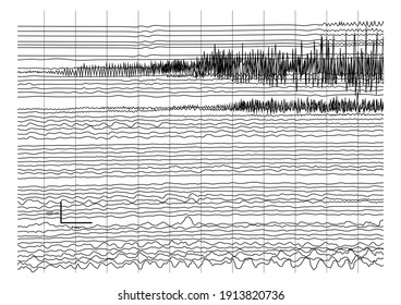 Vector Illustration of ictal EEG recording during seizure. Seizure waves showing propagation of high amplitudes and frequency waves.