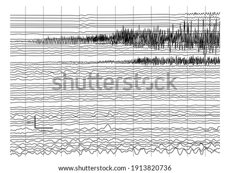 Vector Illustration of ictal EEG recording during seizure. Seizure waves showing propagation of high amplitudes and frequency waves.