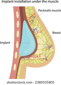 Vector illustration of implant installation under the pectoral muscle. Breast augmentation with implants.