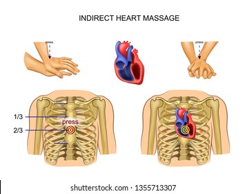 vector illustration of indirect heart massage. regulation