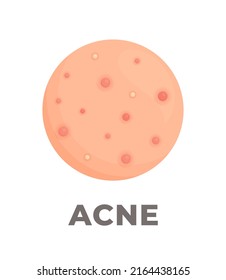 Ilustración vectorial de granos inflamados en la piel. Acné. 