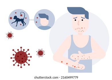 Vector illustration of infographic blue tone showing monkey pox outbreak , man in undershirt showing pain from blisters on skin caused by ingestion of monkeypox virus , flat design.