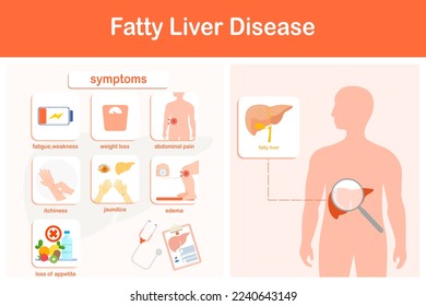 Ilustración vectorial. Infografía de la enfermedad hepática grasa.Debilidad, ictericia, edema, dolor en el lado derecho del abdomen, disminución del apetito y pérdida rápida de peso.estilo plano.